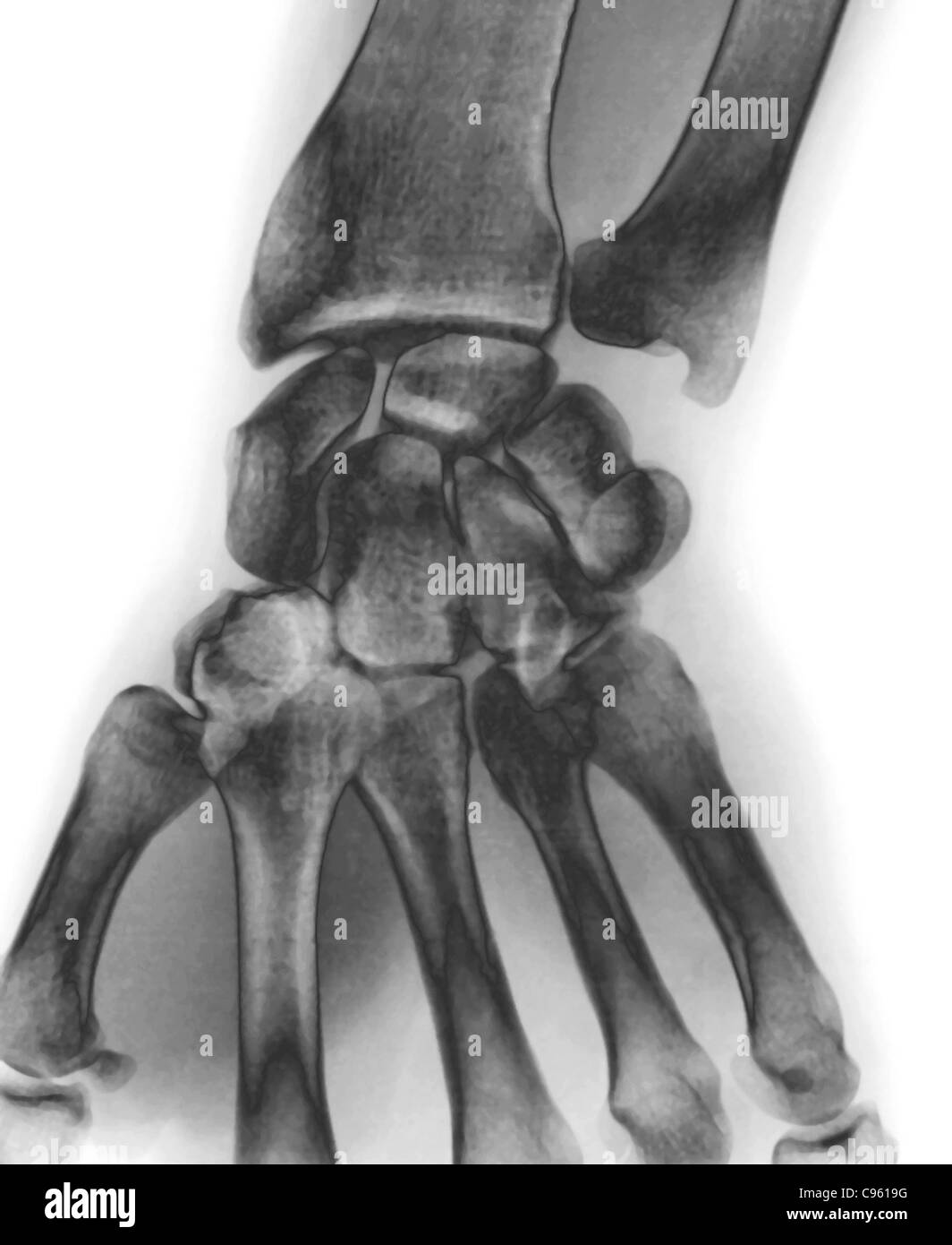 Normal wrist  X-ray. Stock Photo