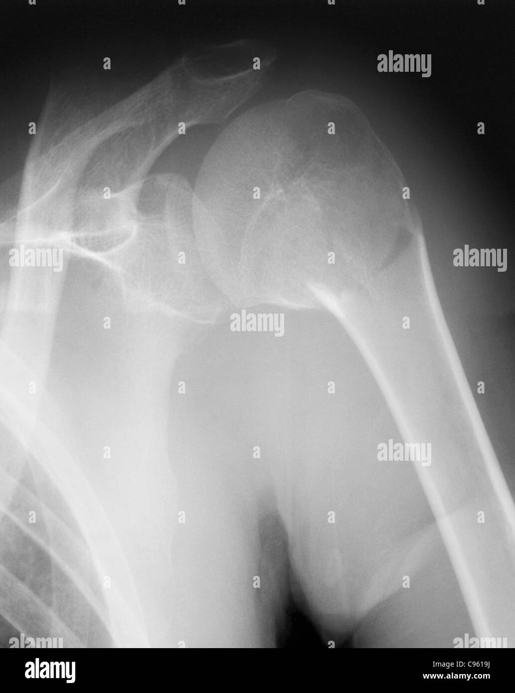 Broken shoulder. X-ray of the shoulder of a patient with a fracture in the neck of the humerus (upper arm bone). Stock Photo
