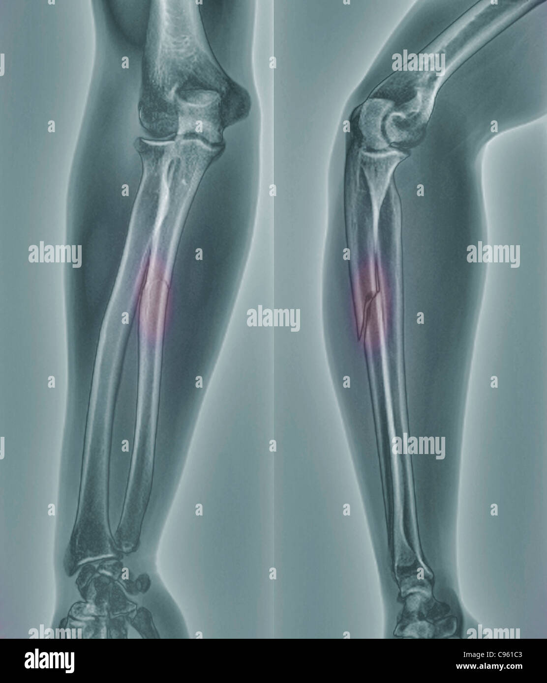 Broken Arm X ray Of The Arm Of A 20 Year Old Patient With A Fractured 