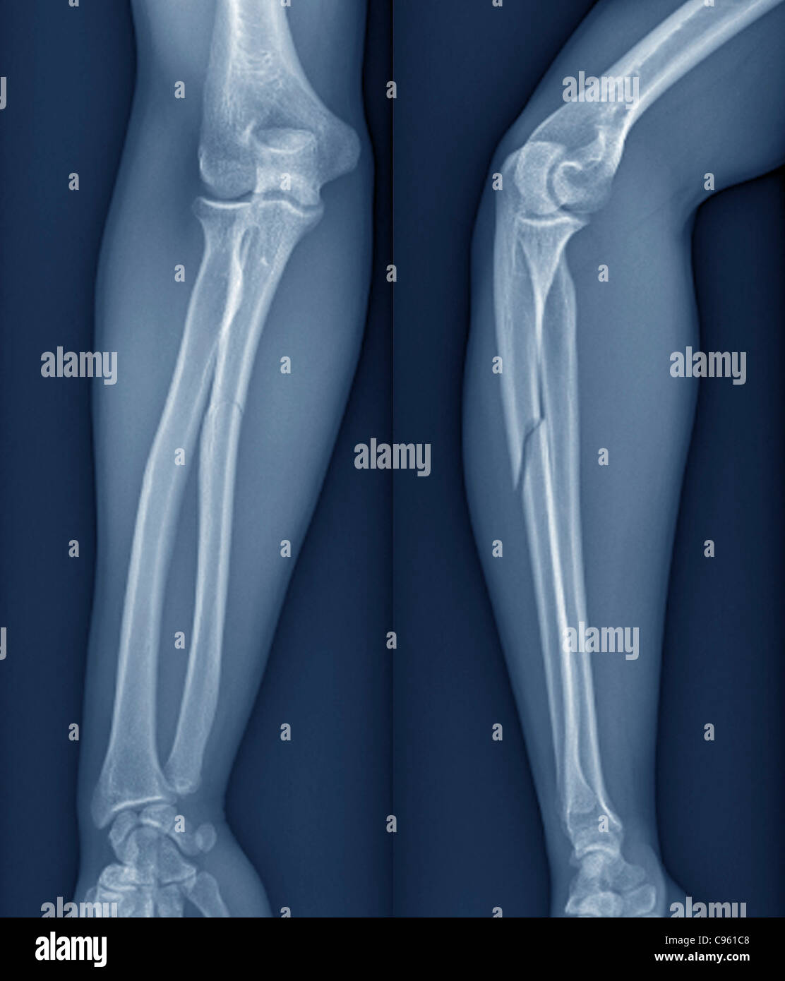 Broken arm. X-ray of the arm of a 20 year old patient with a fractured radius (lower arm bone). Stock Photo