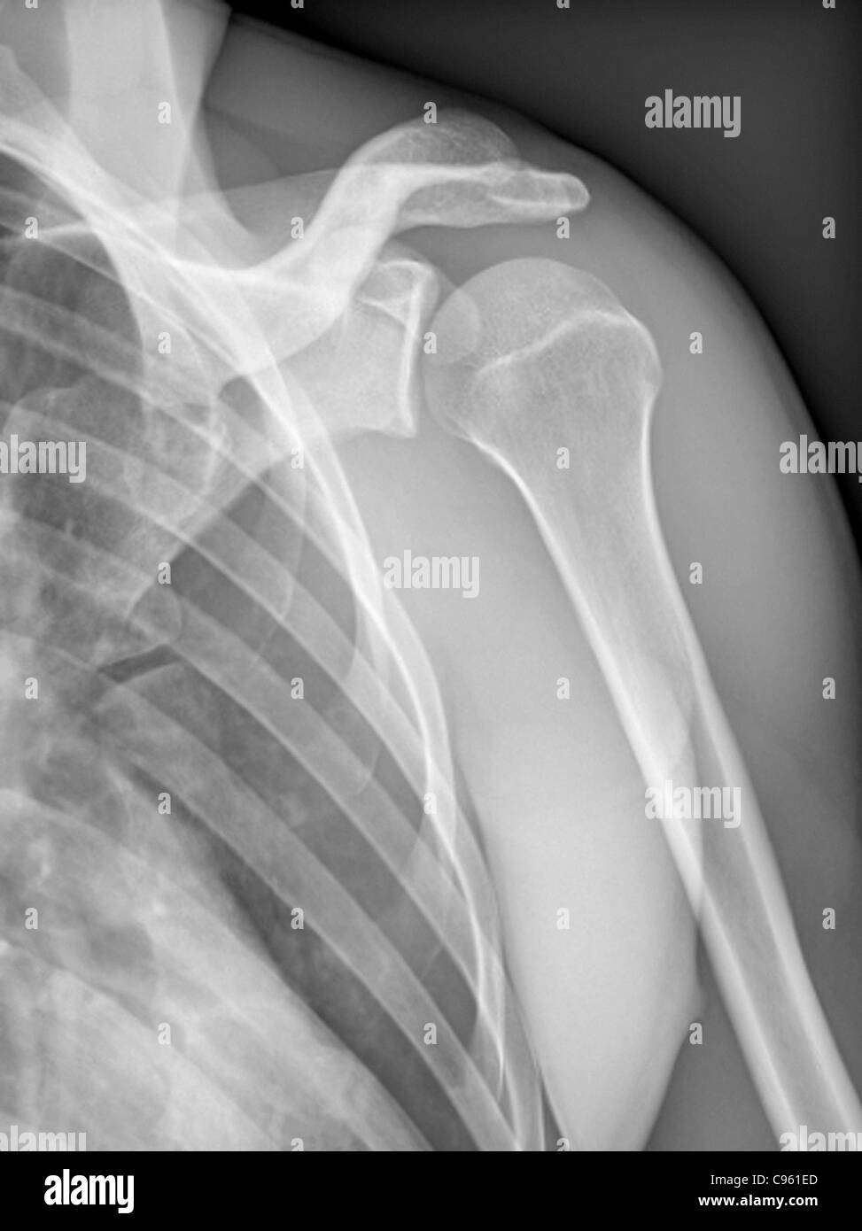 Normal shoulder x ray hi res stock photography and images alamy