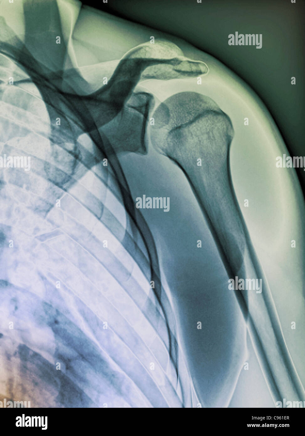 Normal shoulder. Coloured Xray of the healthy left shoulder of a 28 year old patient Stock