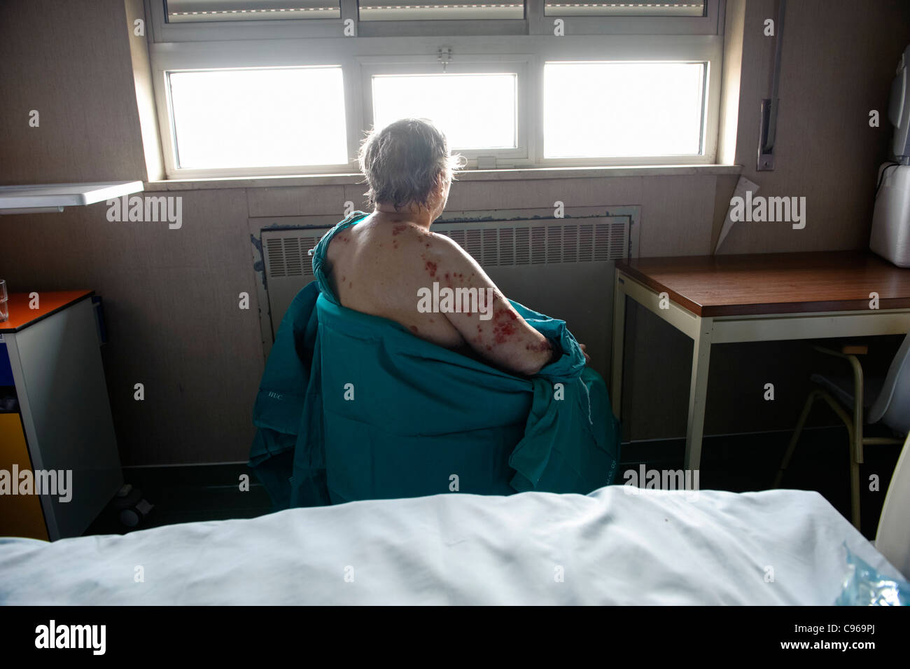 Patient with skin disease sitting by the window Stock Photo