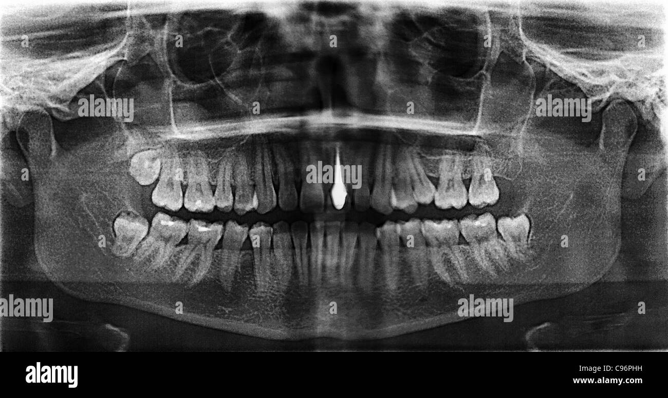 Implanted tooth on a steel pin. Xray of female jaw. Scanned from the