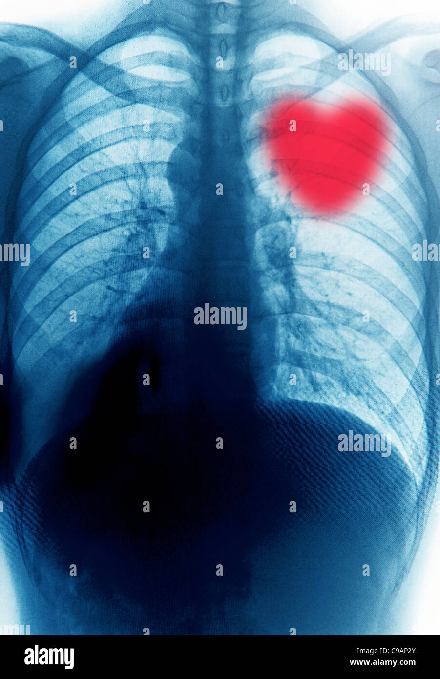 Human heart x ray hires stock photography and images Alamy