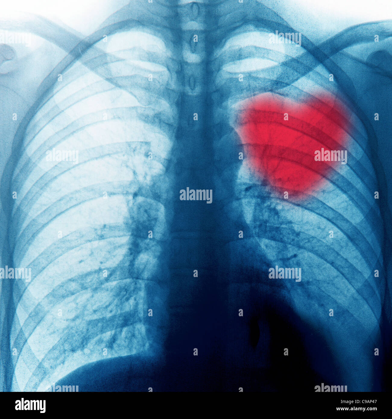 x-ray chest of human bone an red heart Stock Photo
