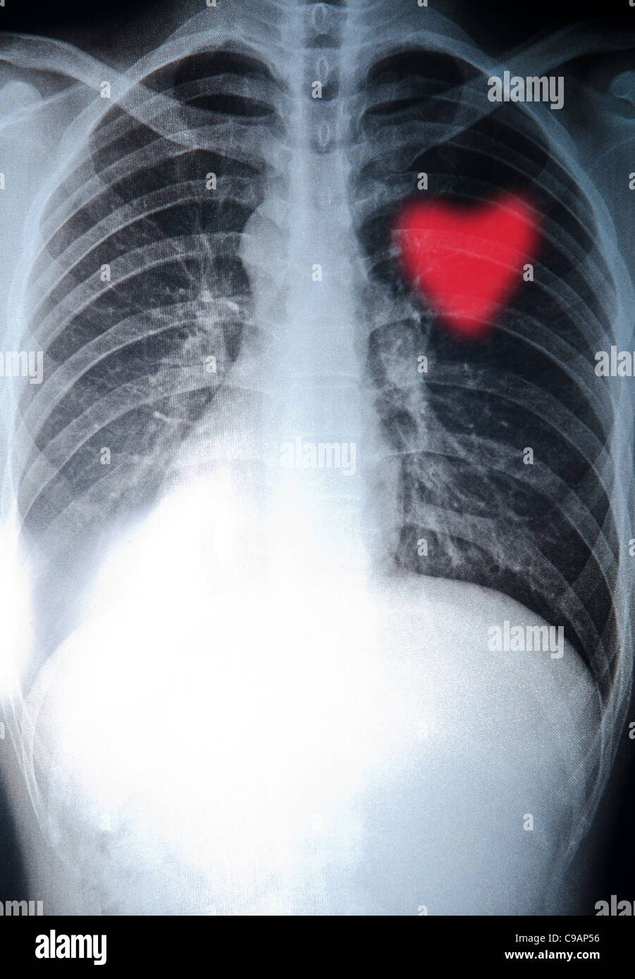 x-ray chest of human bone an red heart Stock Photo