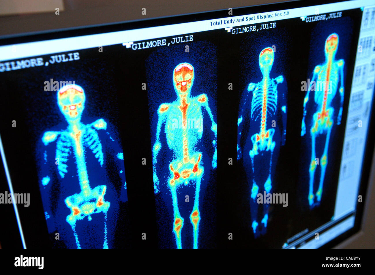 May 25, 2004; Marietta, GA, USA; Lung cancer patient JULIE GILMORE, 36, has a bone scan in the nuclear medicine department of Marietta Hospital. A computer screen shows the bone scan images. Stock Photo