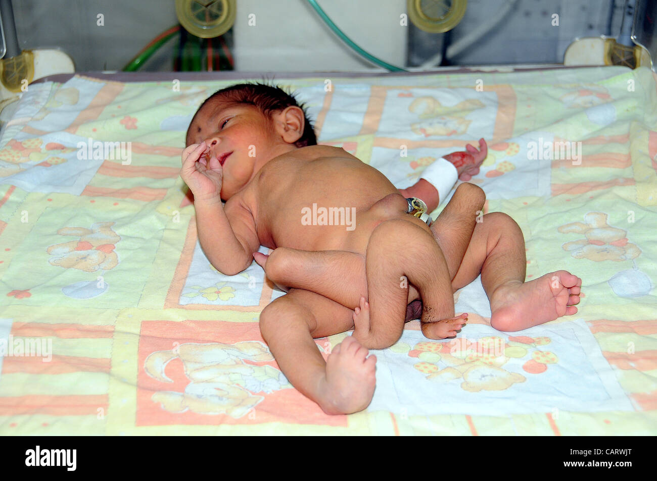 A six legged infant child born in Sukkur few days ago, being treated at National Institute of Child Health (NICH) in Karachi on Monday, April 16, 2012. NICH Director, Dr.Jamal Raza stated that the para normal child having 6 legs is not a single baby instead there are two c Stock Photo