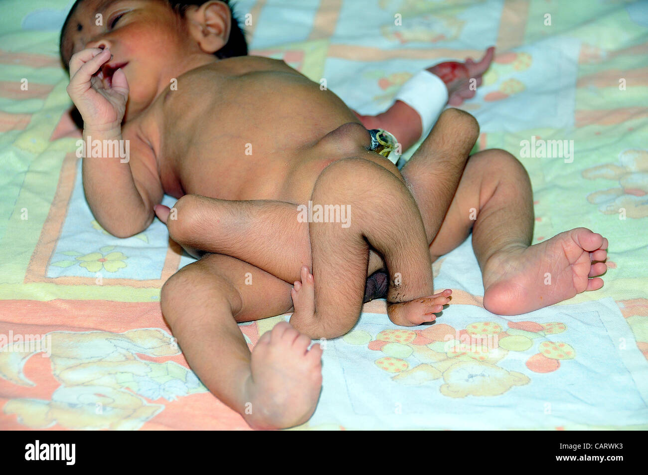 A six legged infant child born in Sukkur few days ago, being treated at National Institute of Child Health (NICH) in Karachi on Monday, April 16, 2012. NICH Director, Dr.Jamal Raza stated that the para normal child having 6 legs is not a single baby instead there are two c Stock Photo