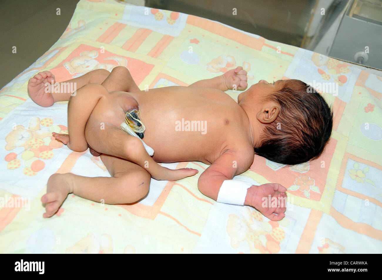 A six legged infant child born in Sukkur few days ago, being treated at National Institute of Child Health (NICH) in Karachi on Monday, April 16, 2012. NICH Director, Dr.Jamal Raza stated that the para normal child having 6 legs is not a single baby instead there are two c Stock Photo