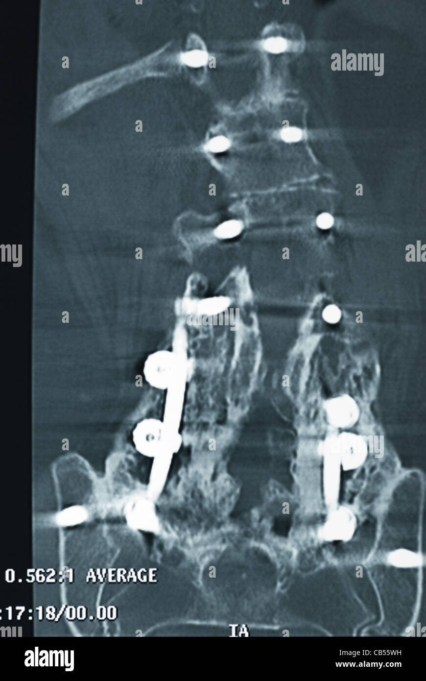 Individual MRI scan of spine with screws Stock Photo Alamy