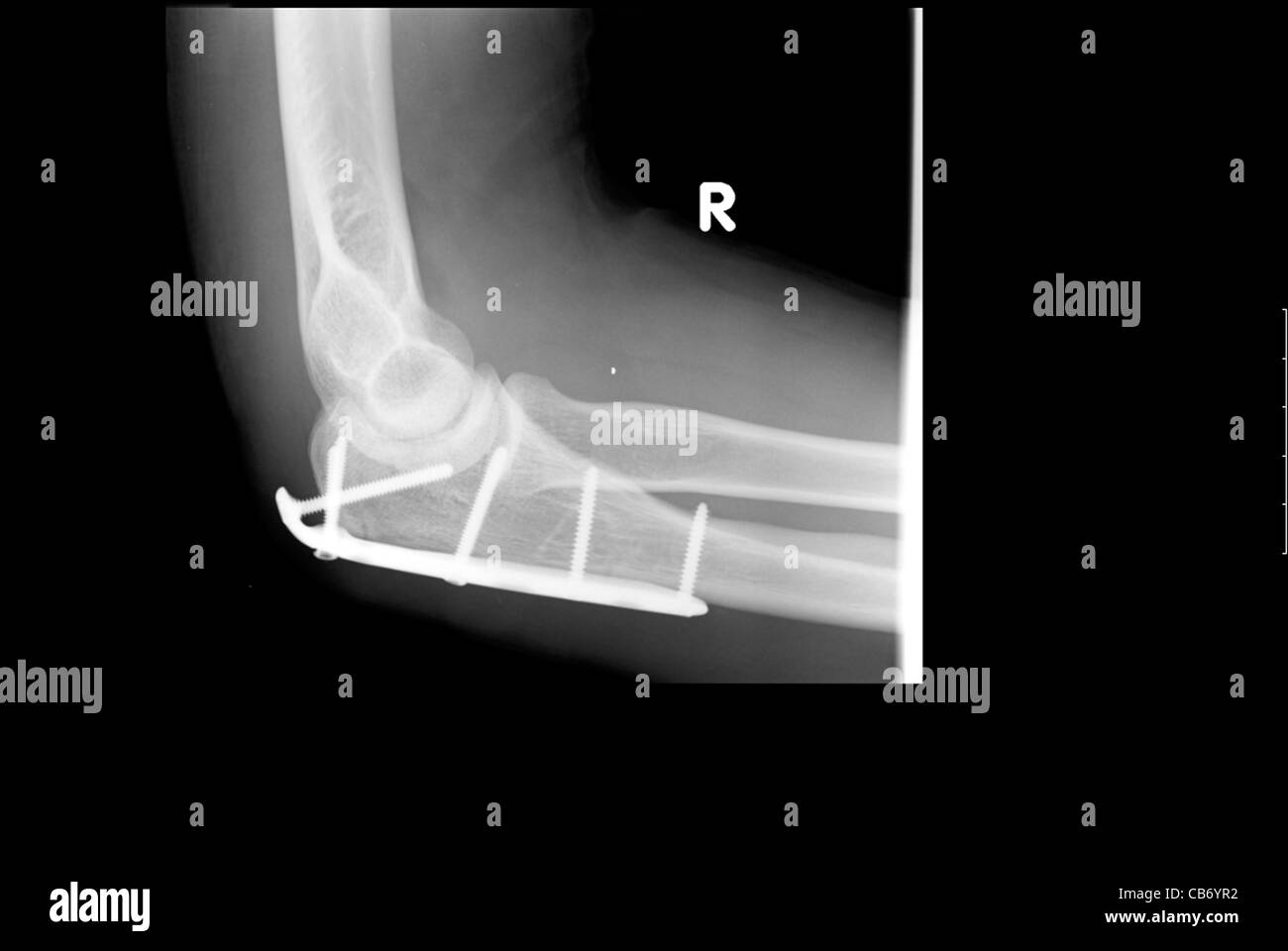 X-ray of a 39 year old male's elbow with surgical pins Stock Photo - Alamy