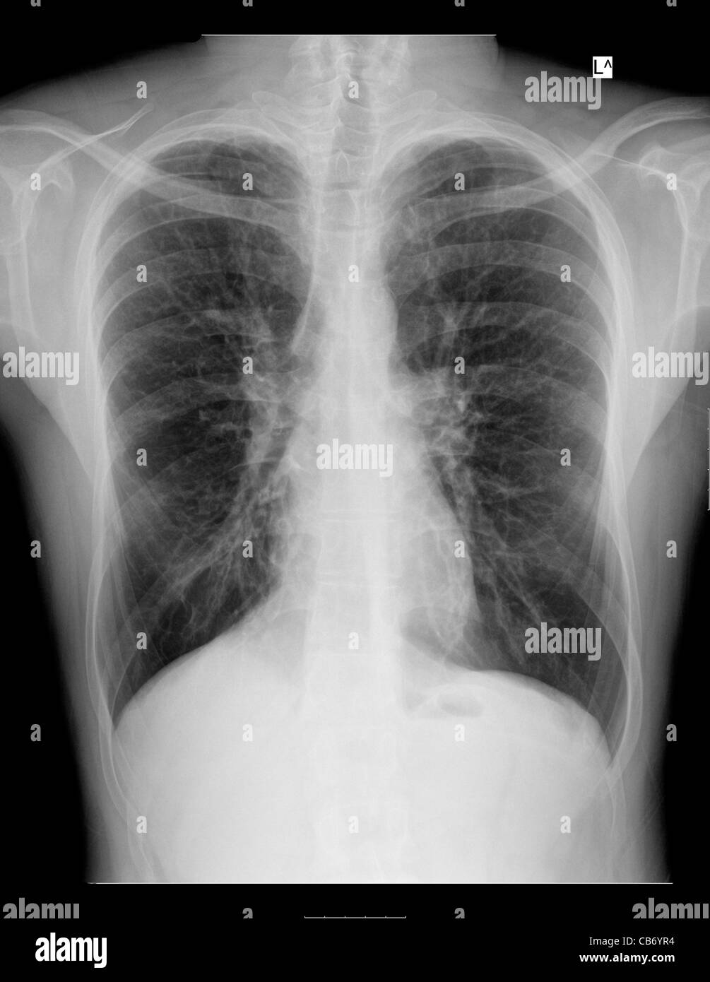 Chest Xray of a 28 year old male patient suffering from Dyspnea due to