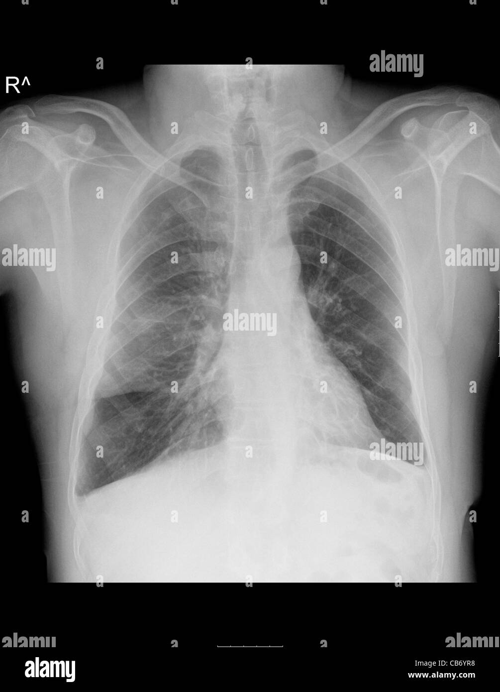 Chest X-ray of a 44 year old male patient with cystic fibrosis (CF) with Pulmonary Manifestation Stock Photo