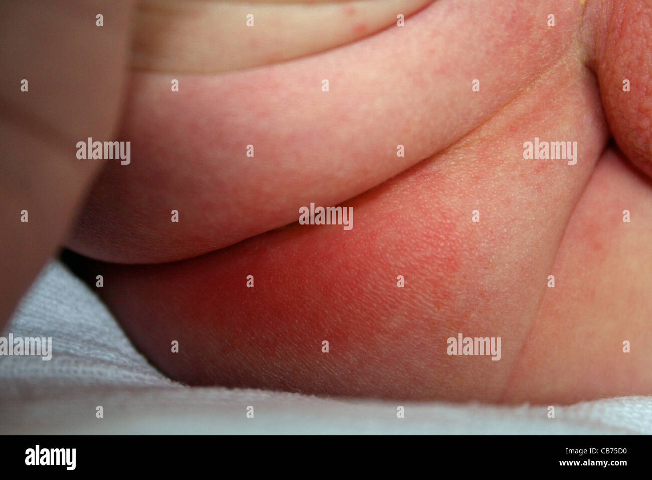 Nappy rash on baby's bottom Stock Photo