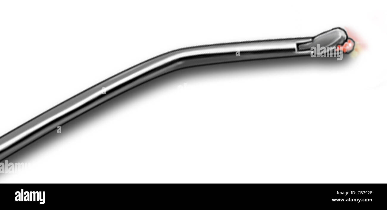 Basket forceps hires stock photography and images Alamy