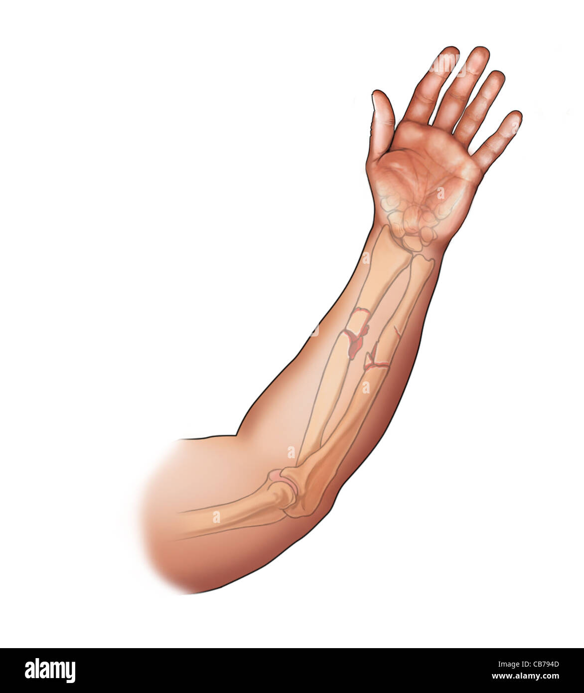 Radius ulna fracture hi-res stock photography and images - Alamy