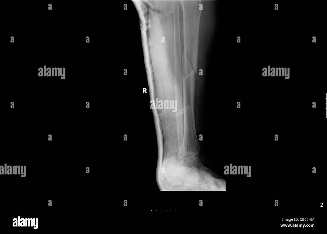 54 Year Old Patient With A Fracture Of The Tibia And Fibula Stock Photo 