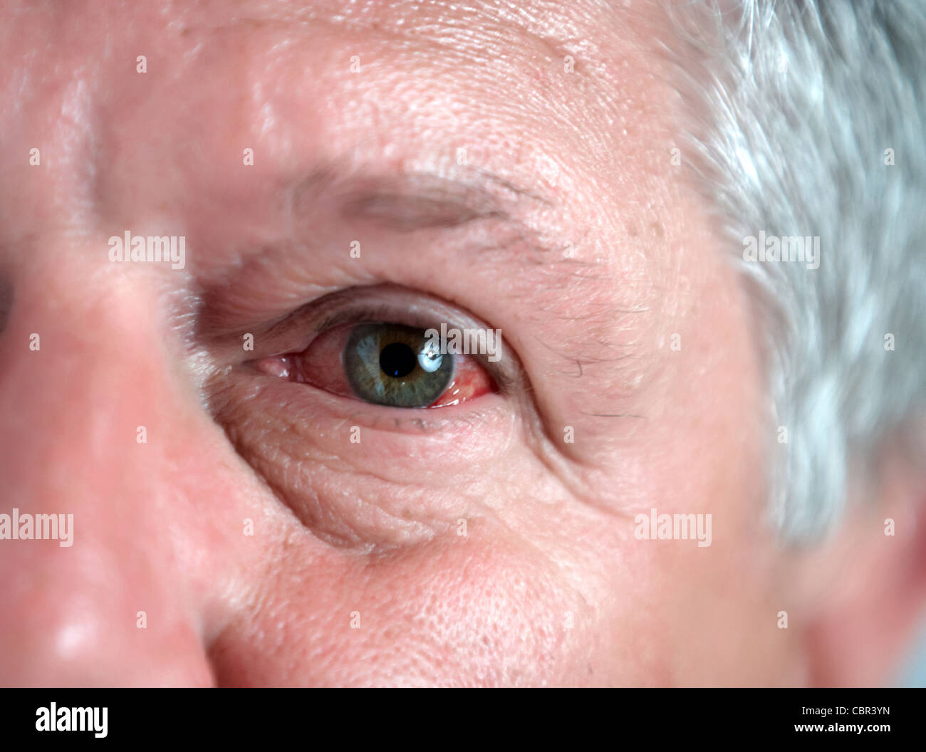 Ebola Bleeding Eyes