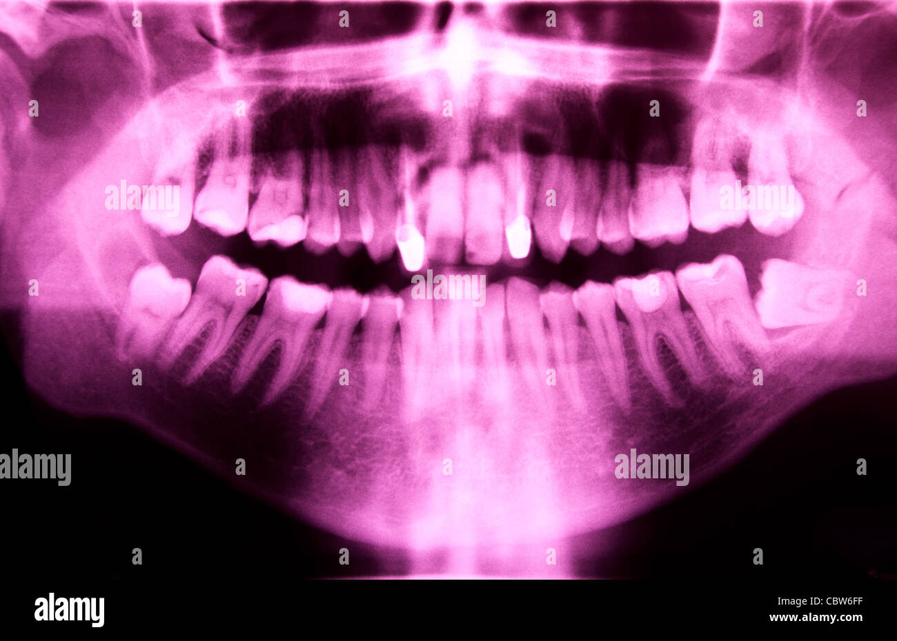 Full mouth panoramic in Xray, showing all the teeth Stock Photo Alamy