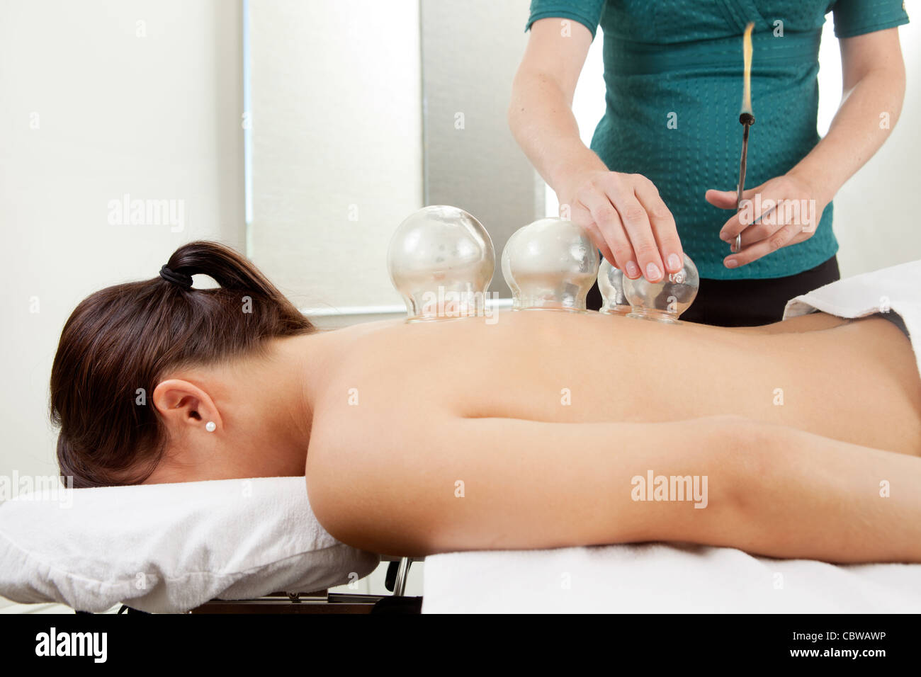 Acupuncture therapist placing a cup on the back of a female patient Stock Photo