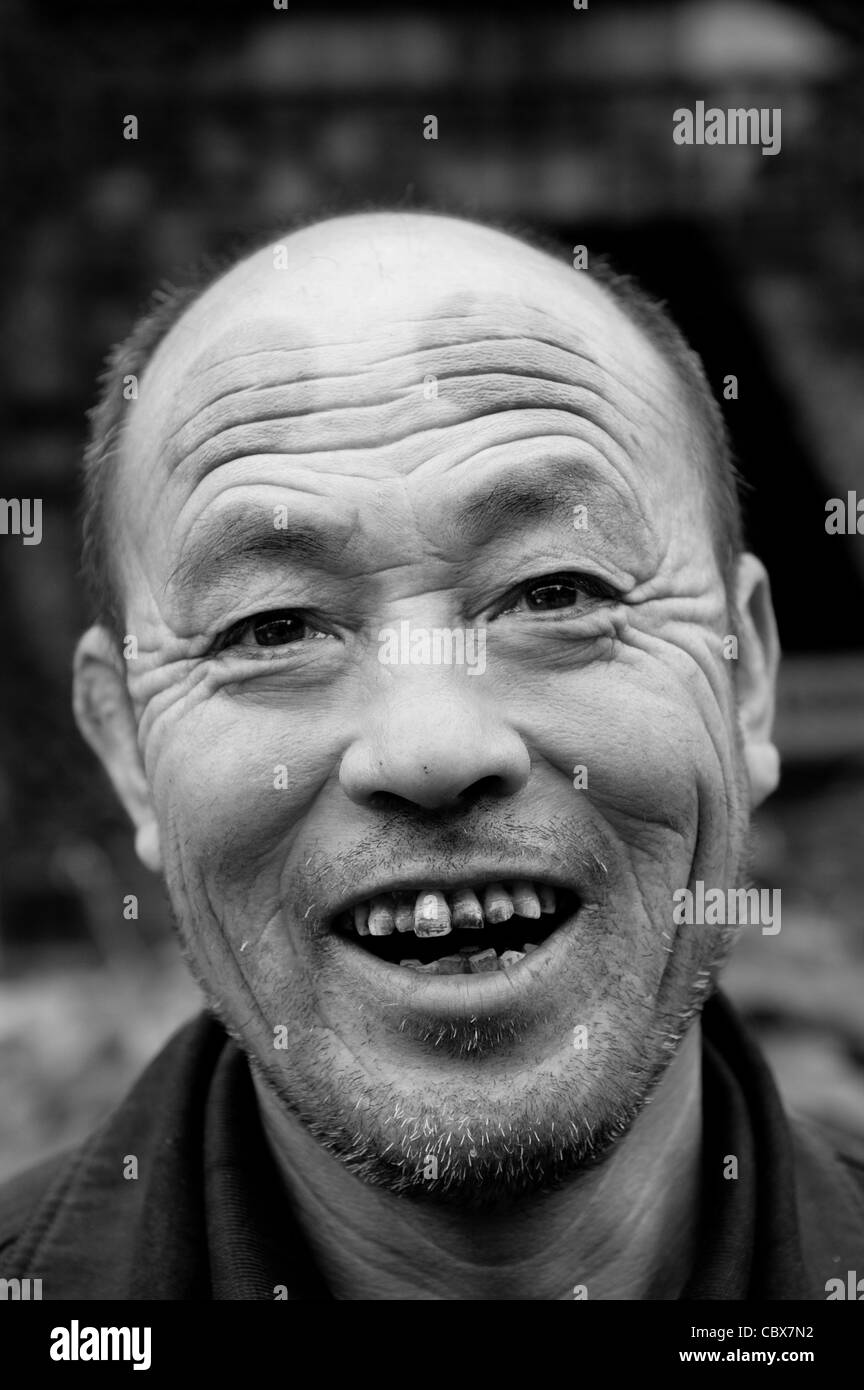 Pingyao. Laughing man with stains from fire cupping on his forehead. Stock Photo