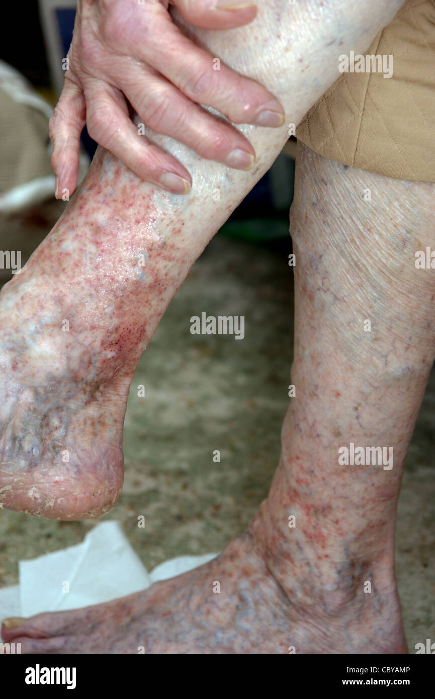 Elderly woman's legs suffering from eczema & varicose veins cream being applied Stock Photo