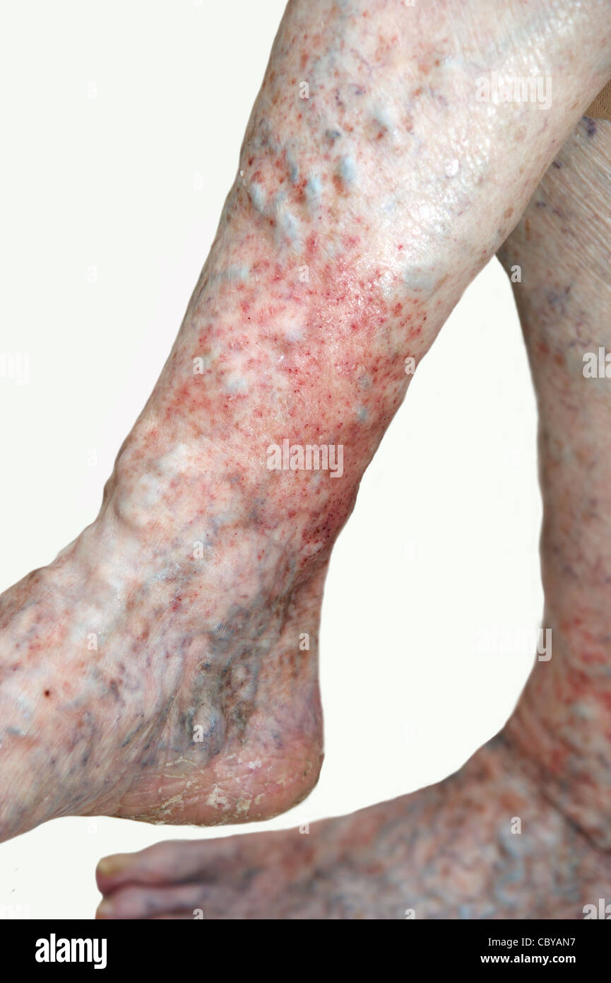 Elderly woman's legs suffering from eczema & varicose veins on a white background Stock Photo