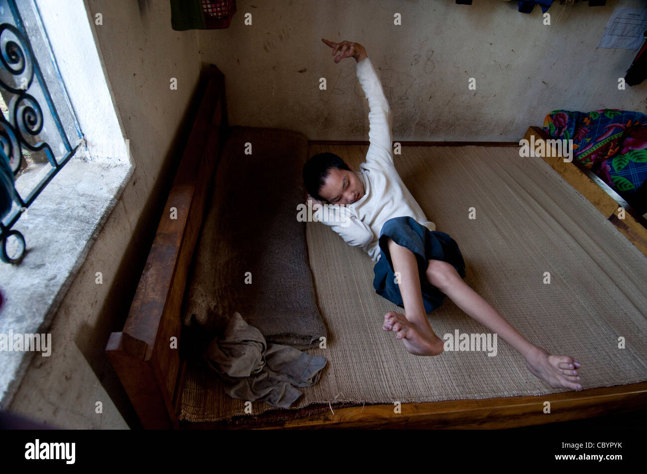 Cerebral palsy (CP) patient, adolescent boy, on a bed in house Vietnam