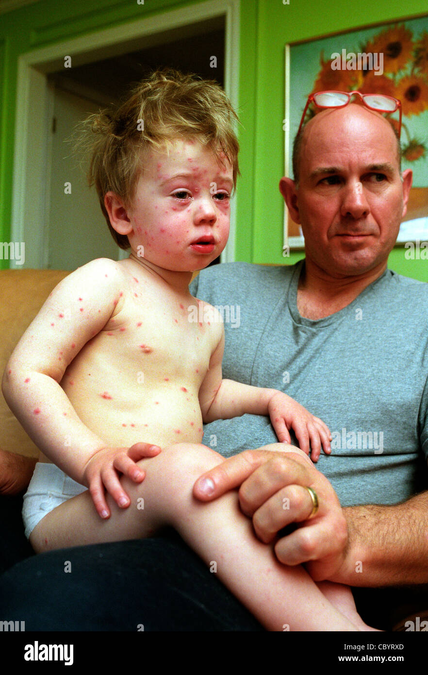 Chickenpox characterised by the appearance on skin and mucous membranes of successive crops of lpruritic vesicular lesions  easi Stock Photo