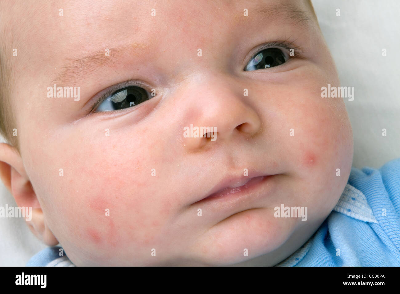 Close up of newborn baby's face with red rash acne and pimples common