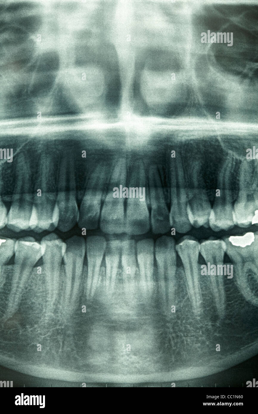 Xray Head High Resolution Stock Photography and Images Alamy