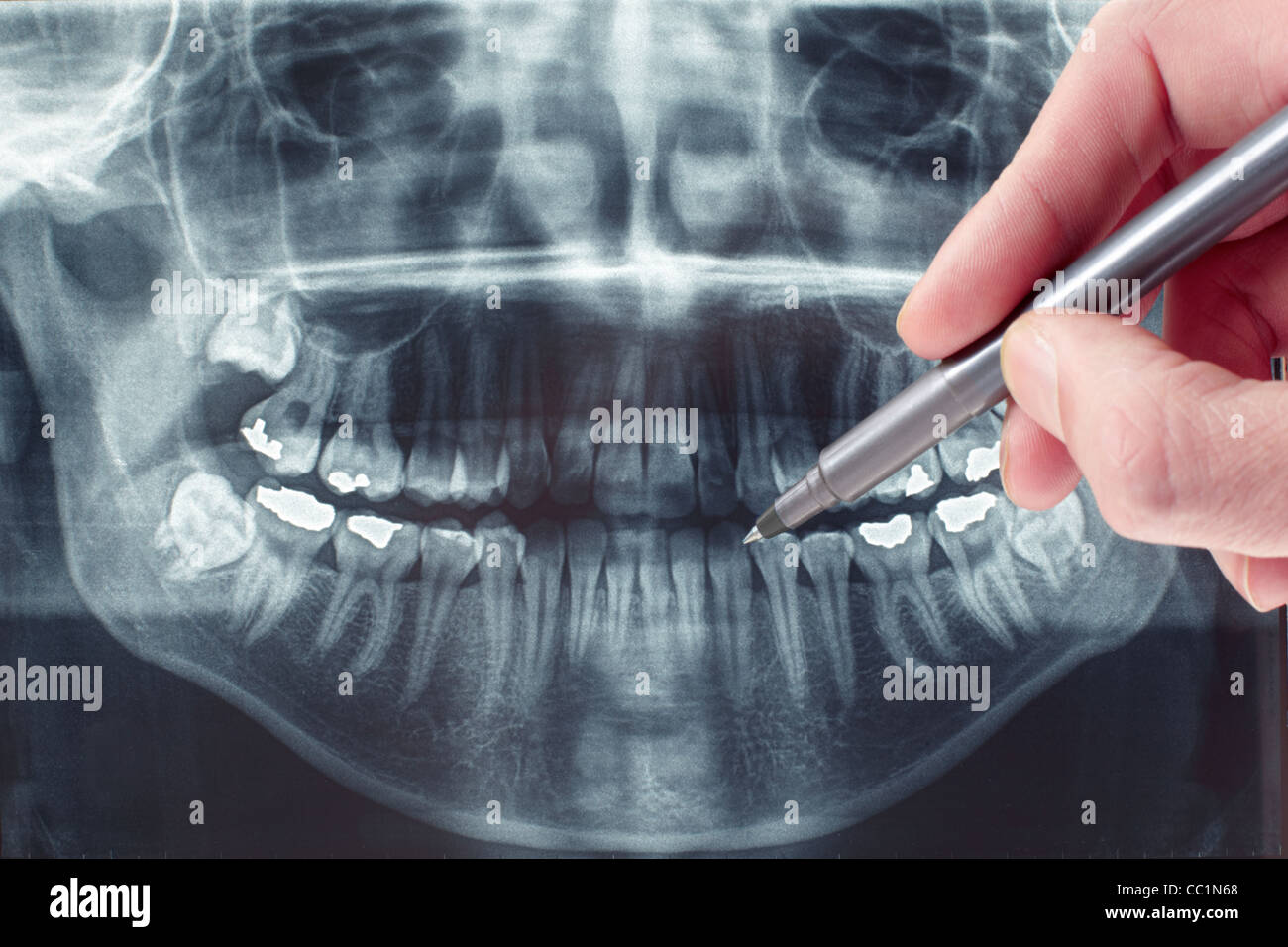 Dental xray Stock Photo