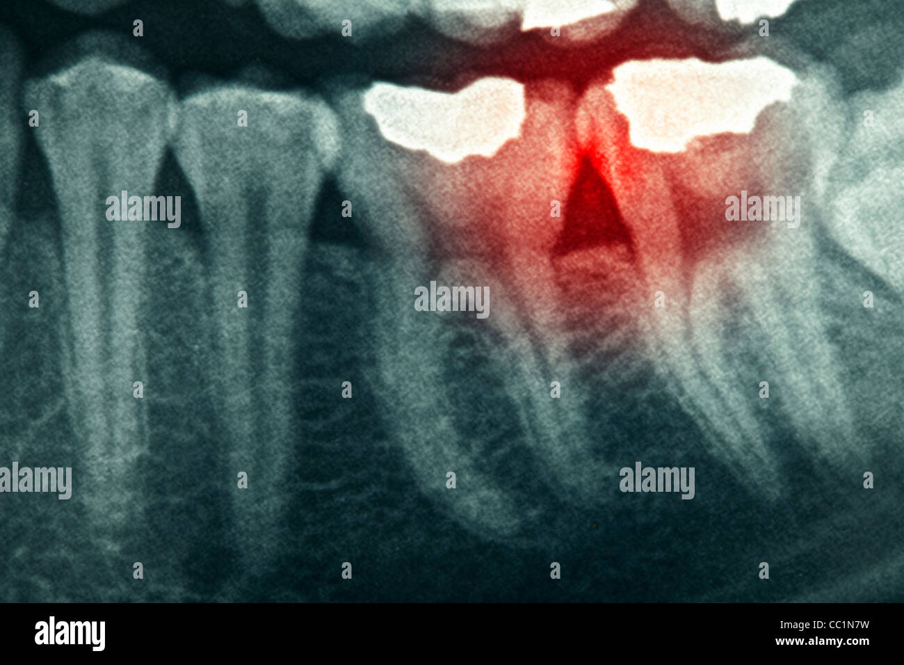 Dental xray with red painful area Stock Photo Alamy