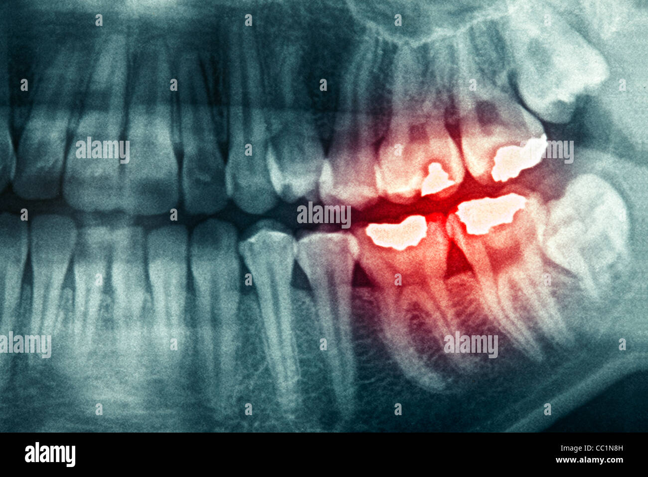 Dental xray with red painful area Stock Photo Alamy