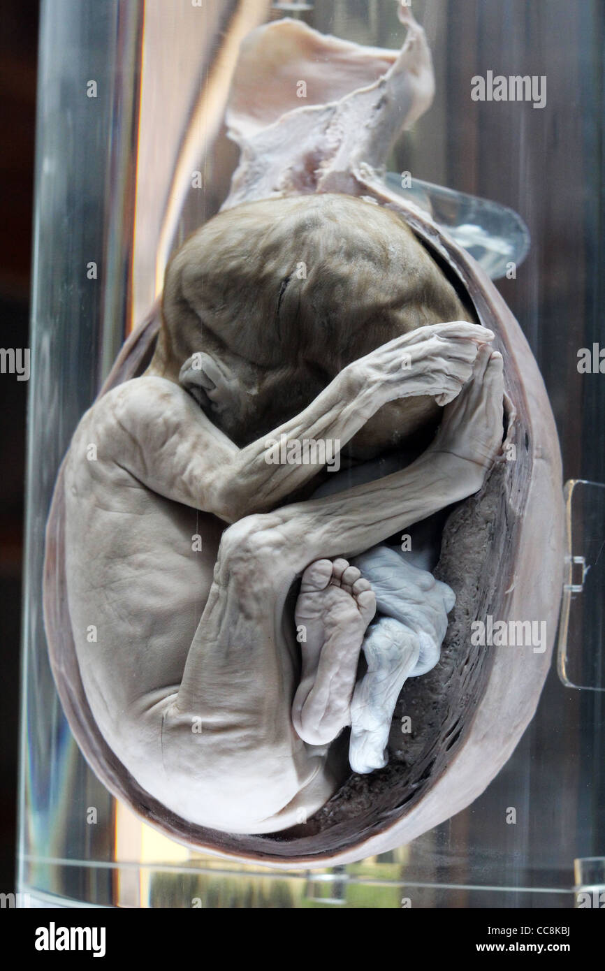 Fetus and placenta. Ancient college of Medicine, Mexico City Stock Photo