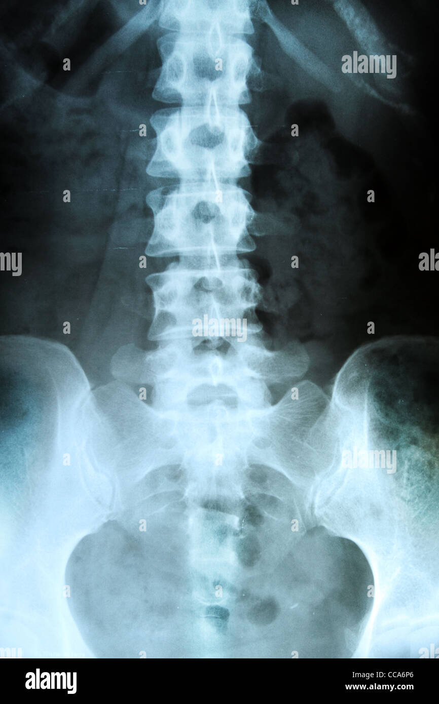 X-ray of the pelvis and spinal column.  Stock Photo