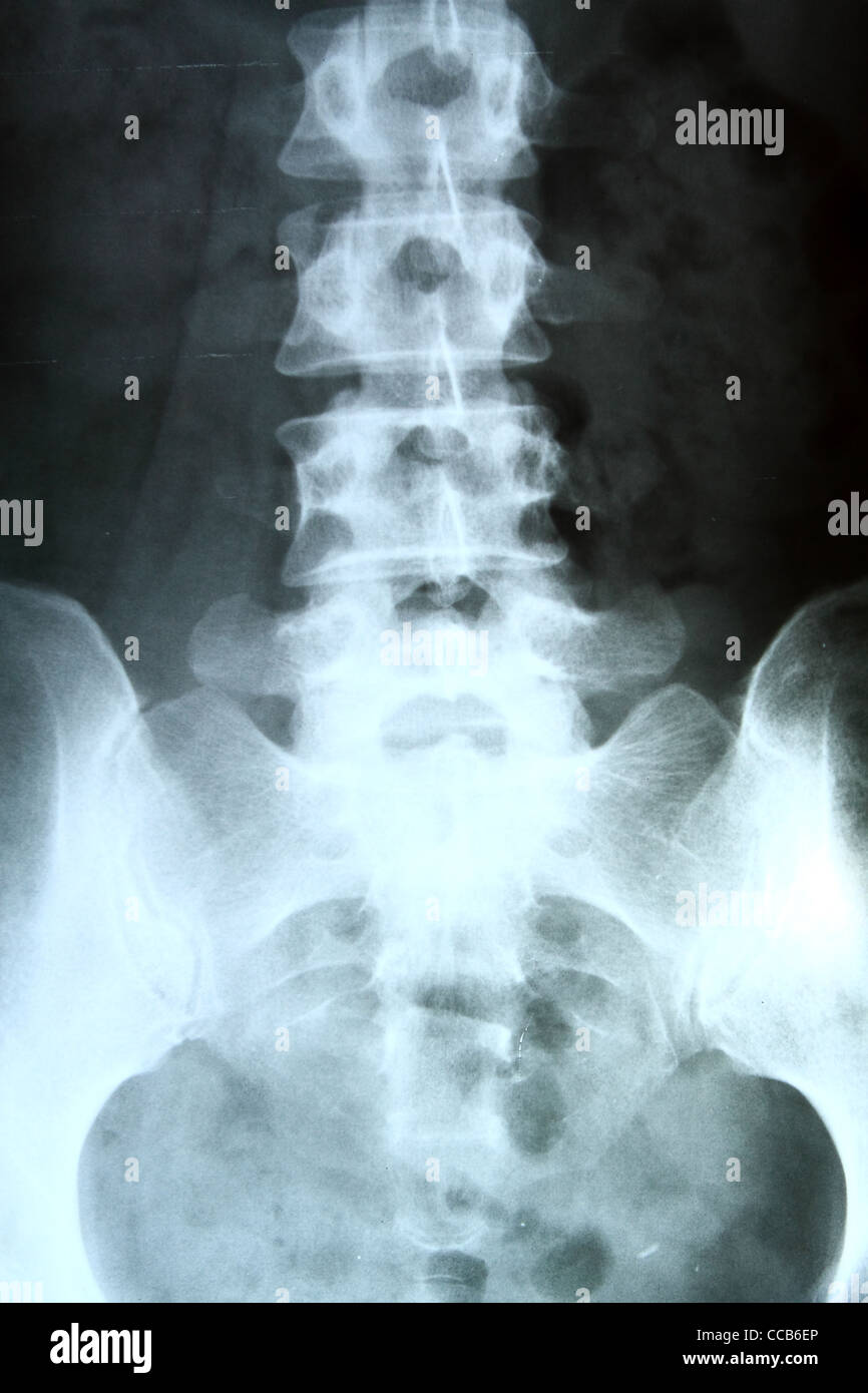 X-ray of the pelvis and spinal column.  Stock Photo