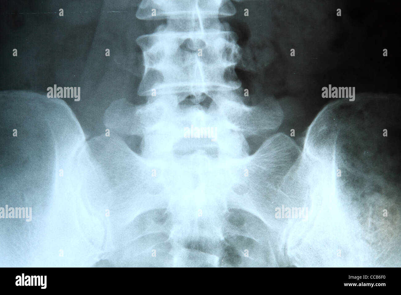 X-ray of the pelvis and spinal column.  Stock Photo