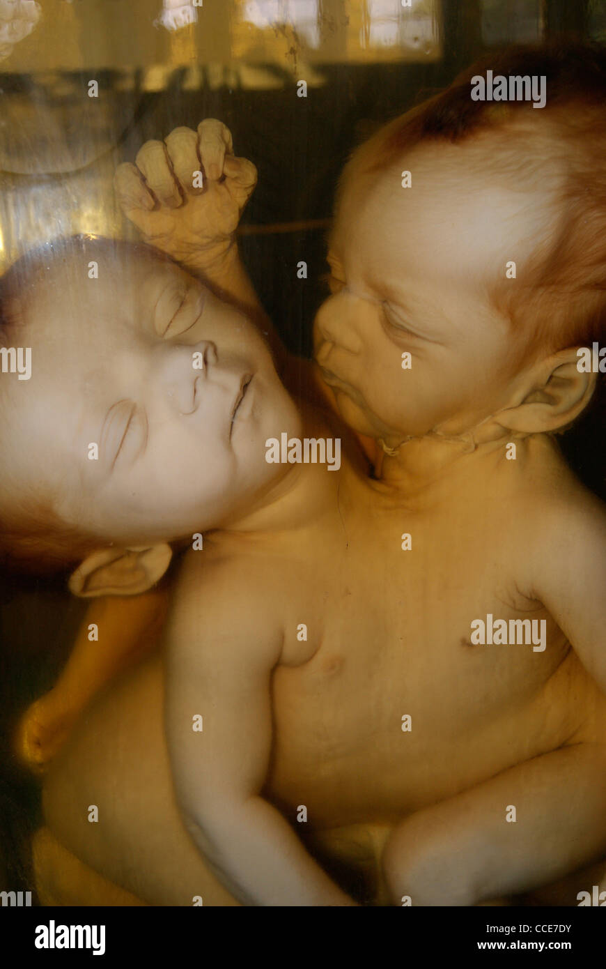 Conjoined Twins double head foetus (Fetus) (Siamese twins) Original Specimen. Stock Photo