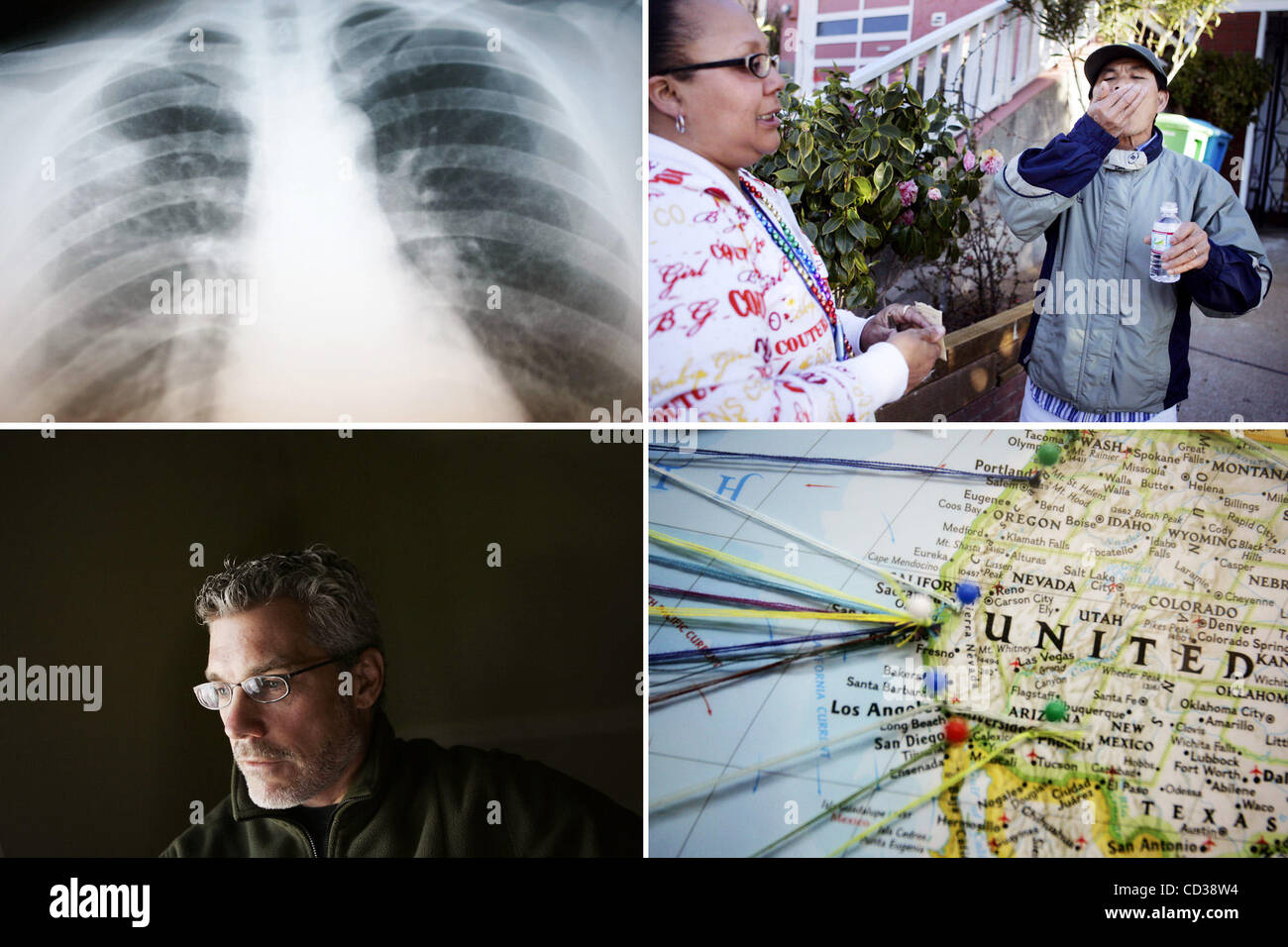 A combo photographs for TB story. Captions:Top left A photograph an X- Ray of a patient who developed active tuberculosis. TB is a genetic shape-shifter; it takes at least six months of antibiotic therapy to cure it. If it is not completely leached from a patient's body, what survives can be a drug- Stock Photo