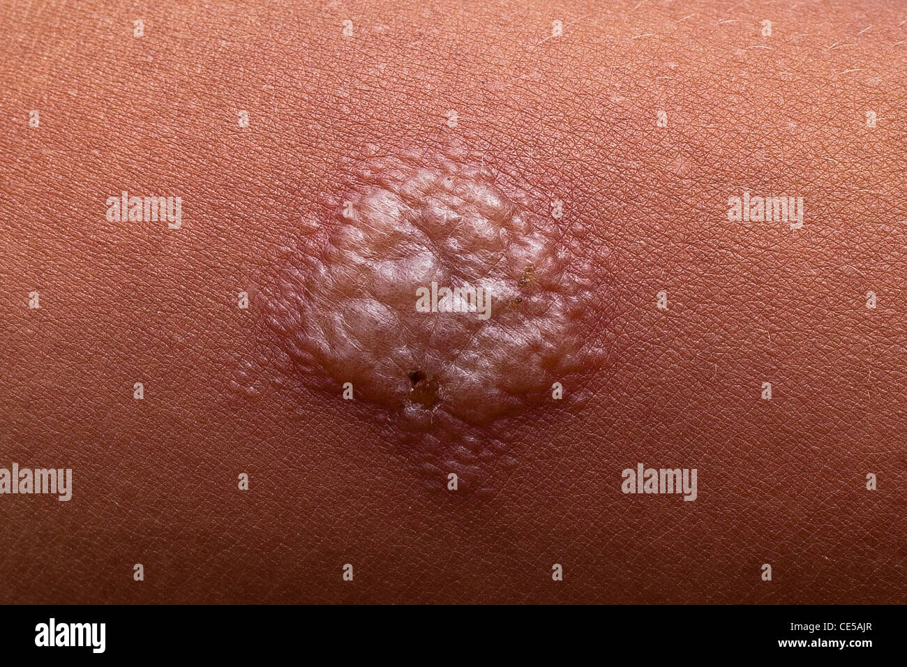 Skin induration detail - the Mantoux test for Tuberculosis involves intradermally injecting PPD (Purified Protein Derivative) tuberculin and measuring the size of induration 48-72 hours later. Mesquita Municipality Tuberculosis Control Program, Rio de Janeiro State, Brazil. Stock Photo