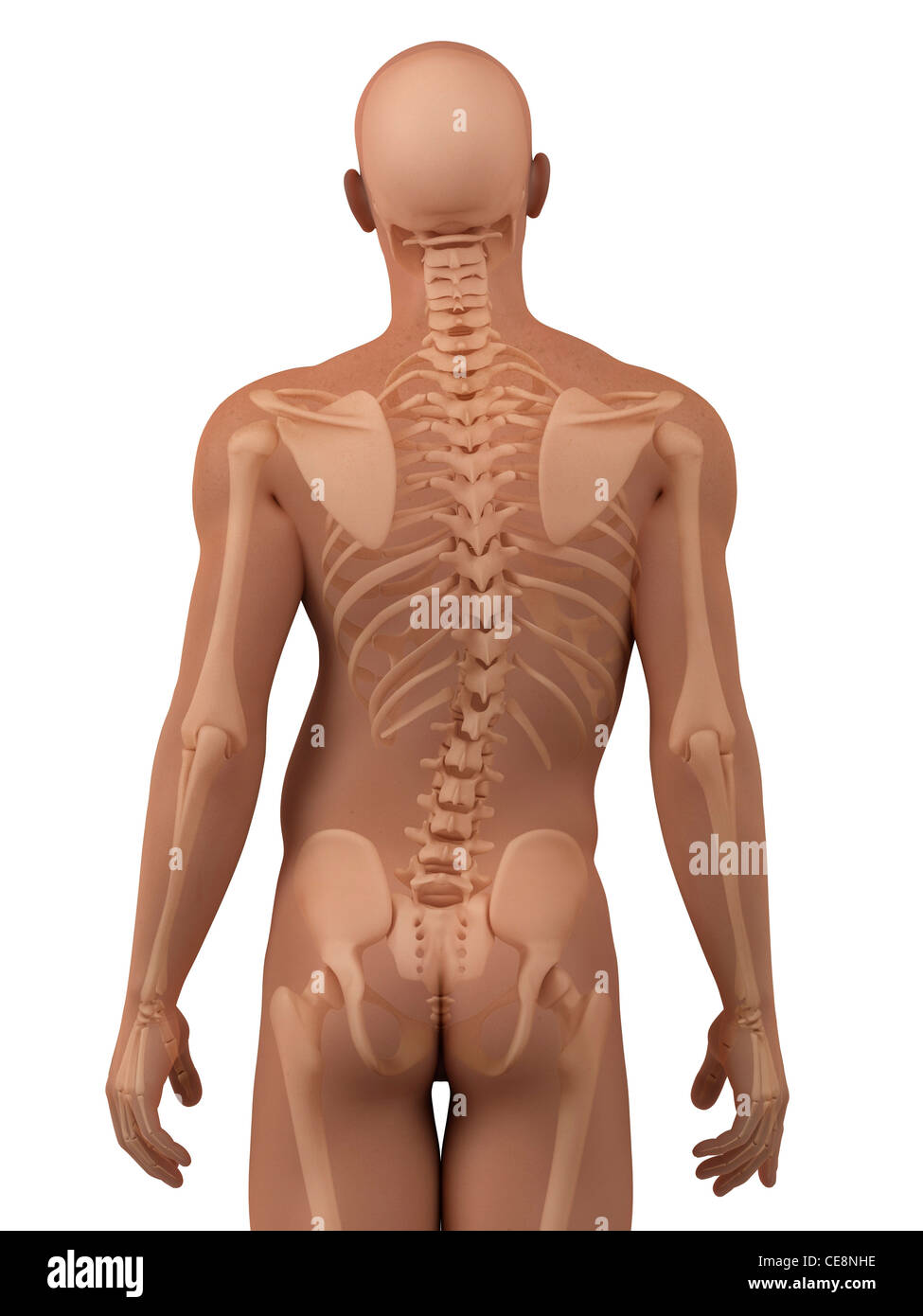 Scoliosis. Computer artwork of a man with a sideways curvature (scoliosis) of the spine. Stock Photo