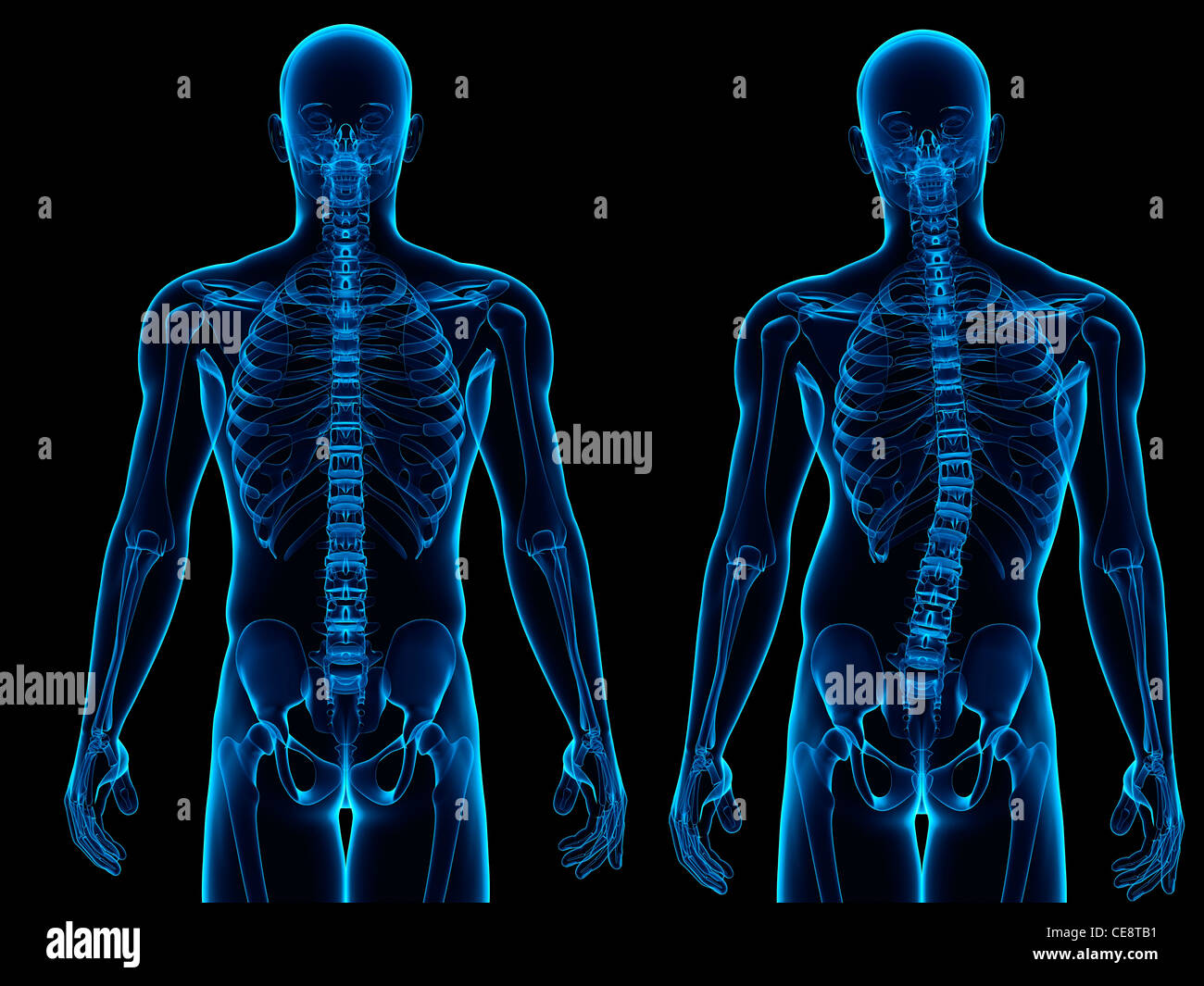 Scoliosis. Computer artwork of a healthy spine (left) and a spine with