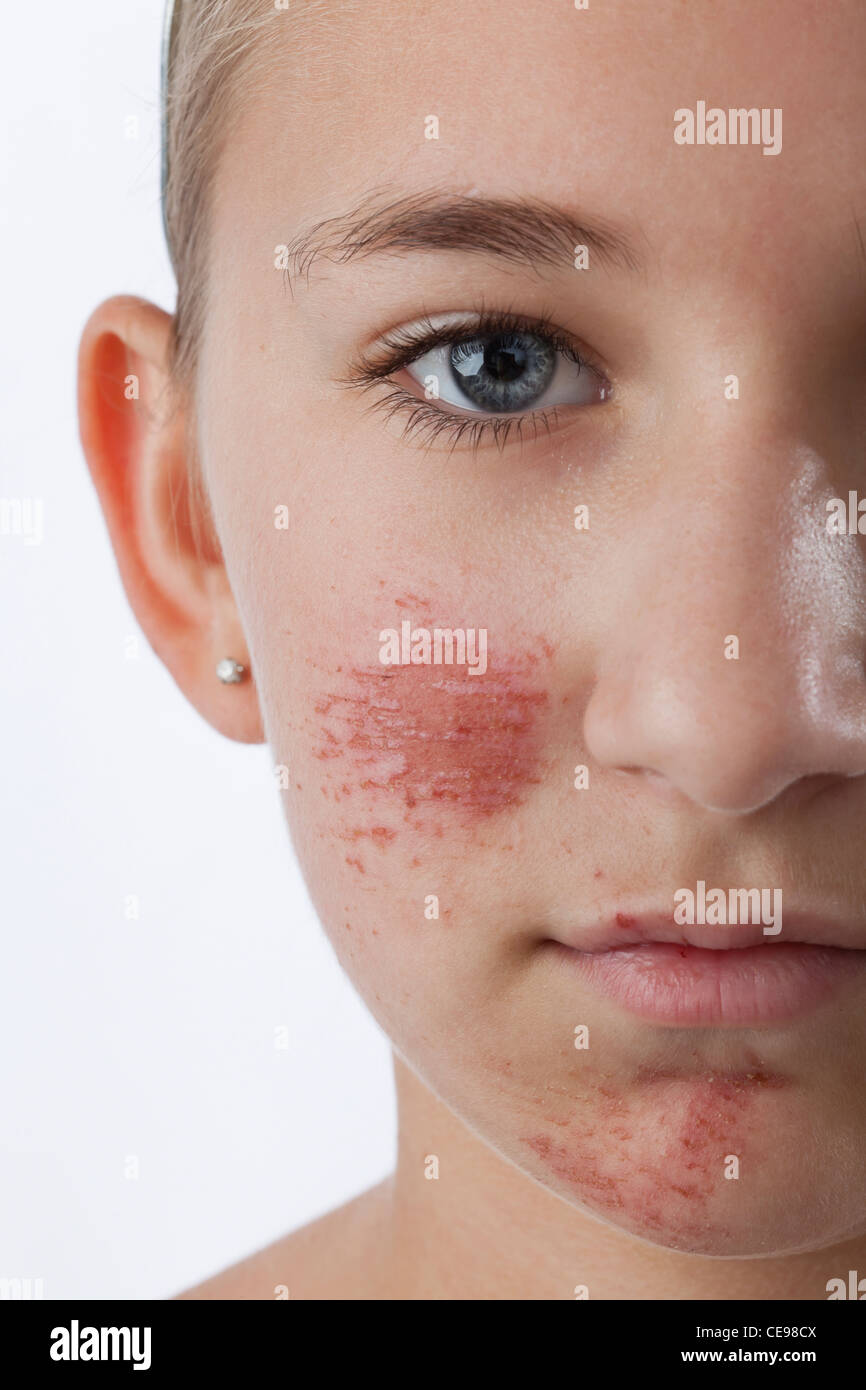 Bruise Child High Resolution Stock Photography and Images Alamy