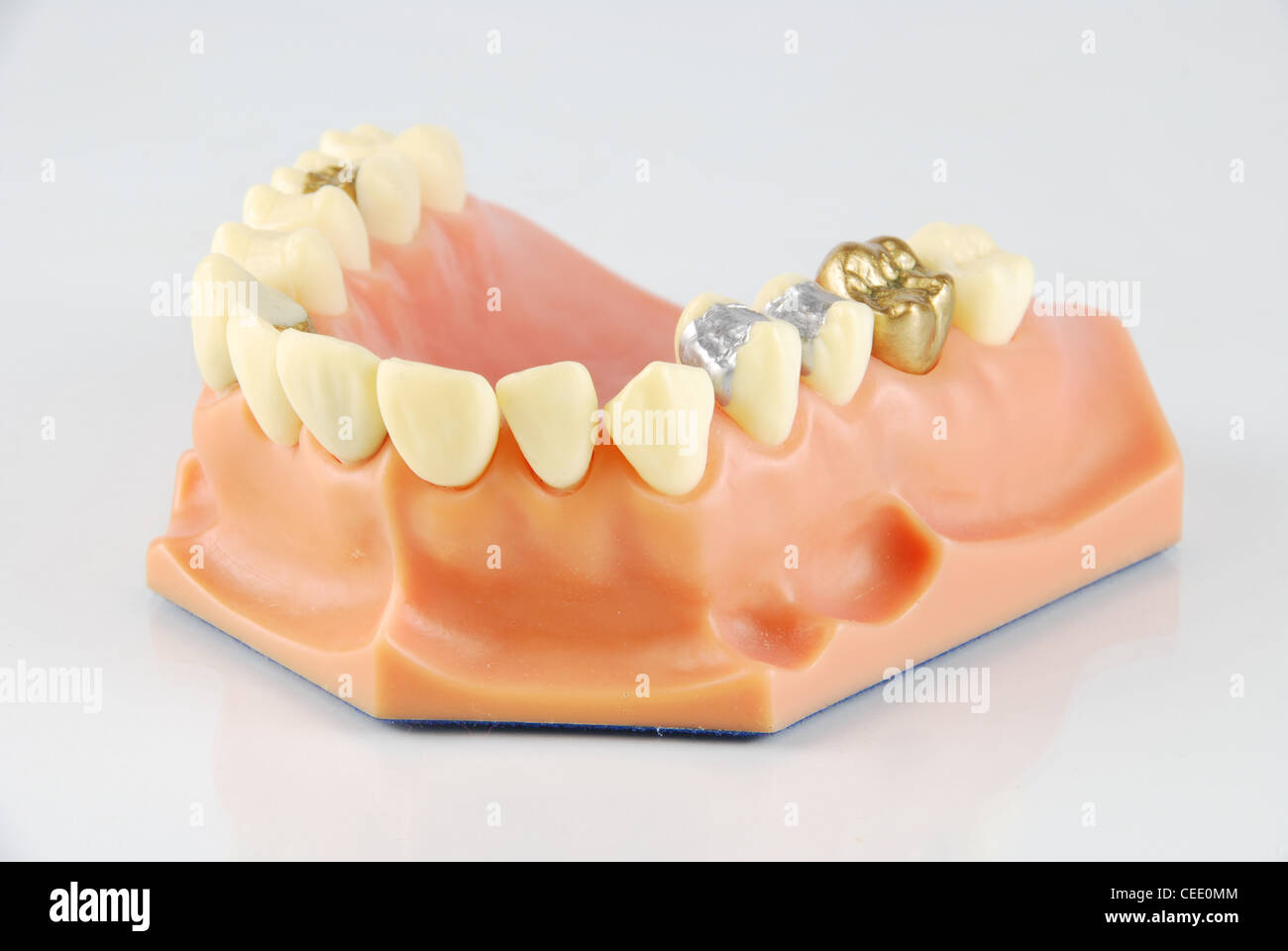 Dental model (with different treatments) Stock Photo