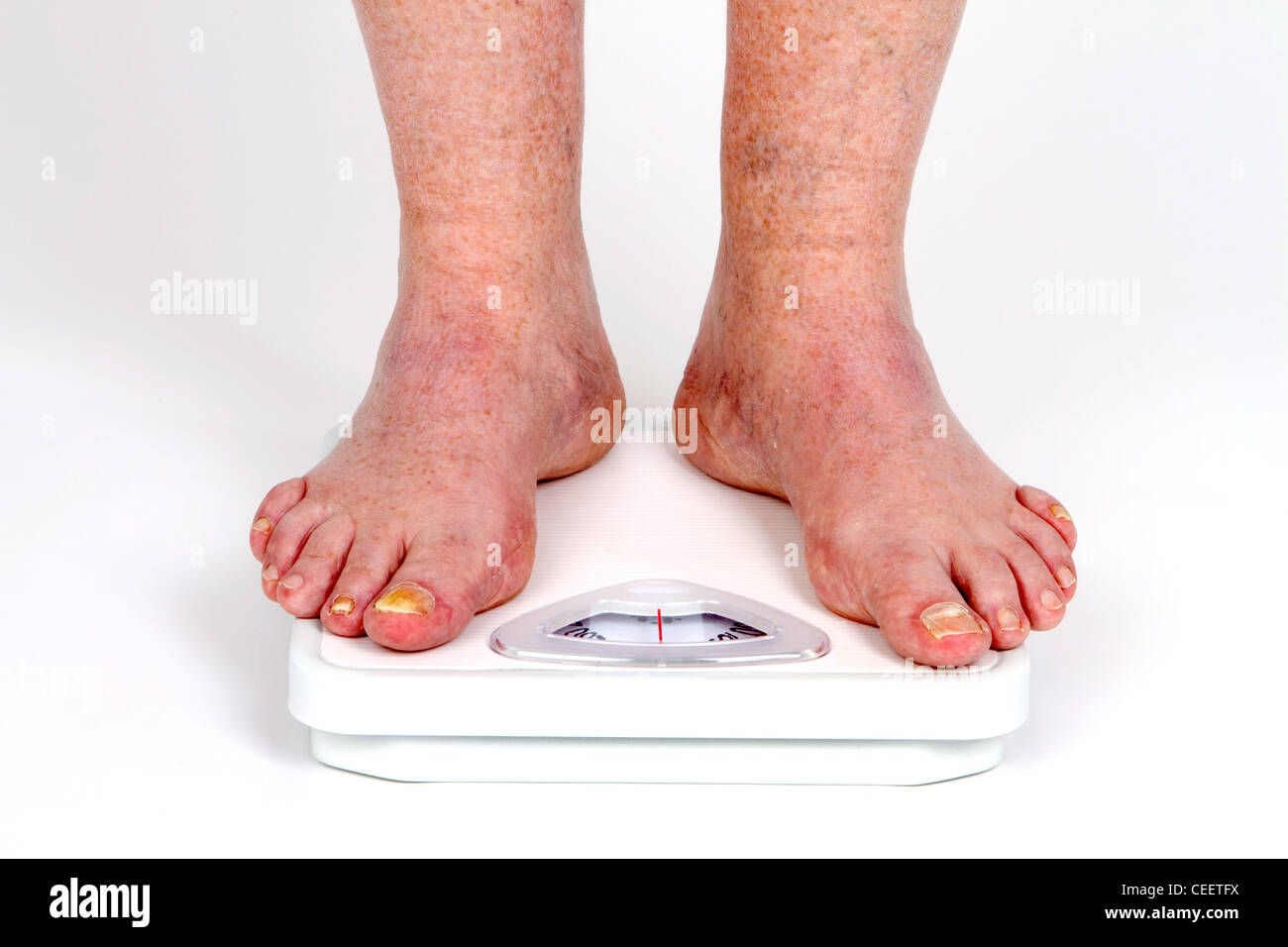 Mature man's feet on scale as he takes his weight measurement with toe fungus disease. Stock Photo