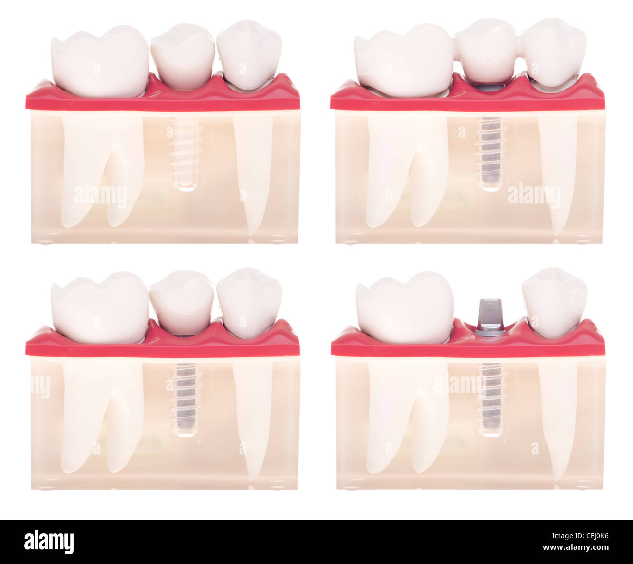 Dental model with different types of treatments Stock Photo Alamy