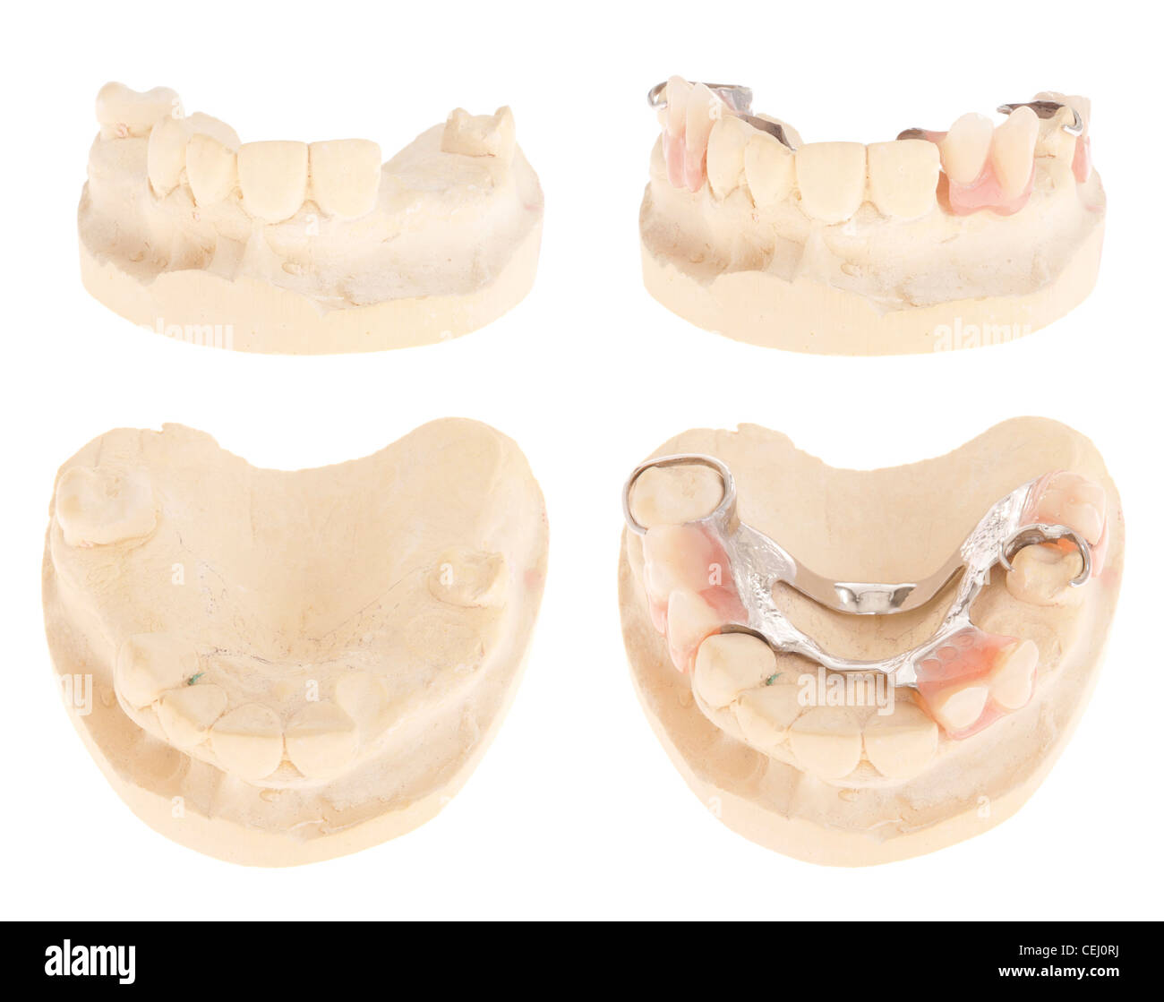 Chrome cobalt denture Stock Photo Alamy
